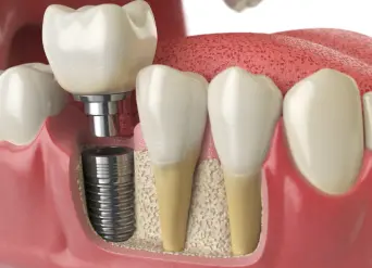 Helpful dental information about dental implants Moreno Valley